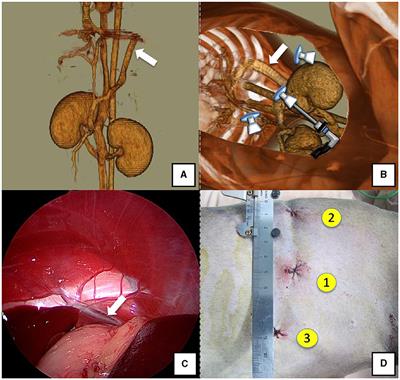 Laparoscopic treatment of congenital portosystemic shunts with portal pressure measurement and portal angiography in 36 dogs